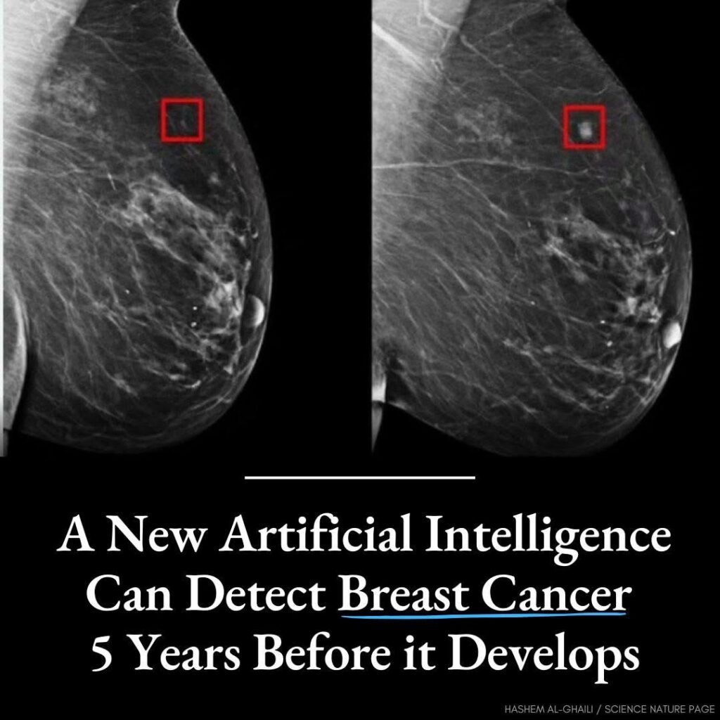 Una nueva inteligencia artificial puede detectar el cáncer de mama 5 años antes de desarrollarse