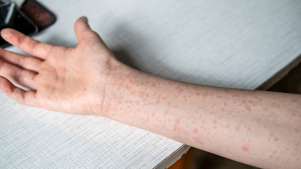CDC monitorea brote de Sarampión en los Estados Unidos