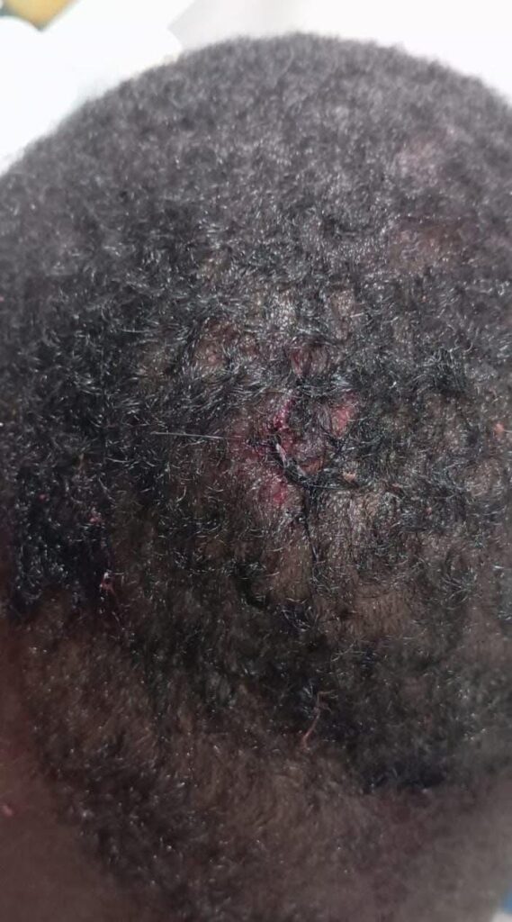 Se agrava estado de salud del guardaespaldas del alcalde de Dajabón, atacado por haitianos